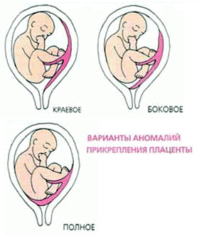 Беременность: предлежание плаценты
