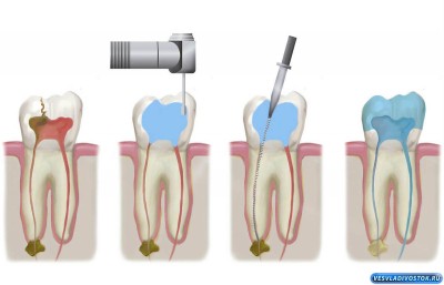 Почему за качественным лечением и диагностикой зубных корневых каналов следует обращаться в клинику «Стоматика»