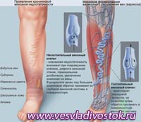 ВАРИКОЗ МОЖЕТ ВЫЗВАТЬ ОСЛОЖНЕНИЯ